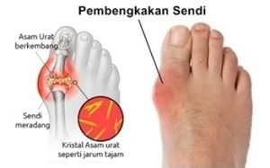pembekakan sendi