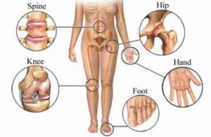 osteoartritis
